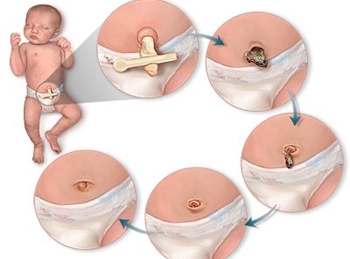 新生儿脐部护理清洁措施